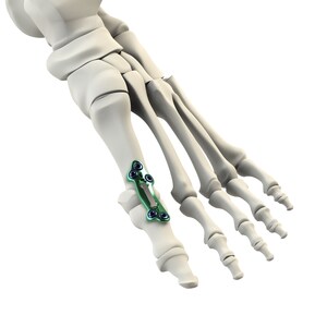 CrossRoads® Extremity Systems Announces Launch of the Active Stabilization™ MPJ Implant System