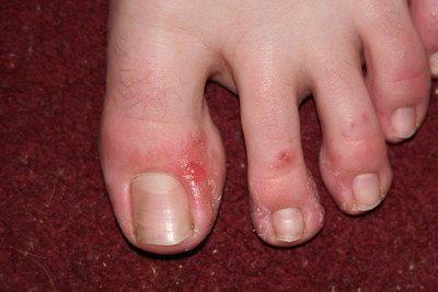 Pediatric case of foot dermatitis. copyright: SmartPractice