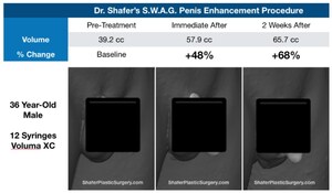 SWAG Penis Enhancement Procedure Developed by Top Plastic Surgeon Achieving Optimal Results