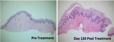 Histology of the vaginal canal mucosa before (left) and at Day 120 after (right) treatment with TTCRF. Post treatment, there was improvement in mucosal maturation with increased number of cell layers, increased papillary dermis, no flattening of the rete ridges, improved glycogenation, and denser stroma. Hematoxylin and eosin, 100X. TTCRF, transcutaneous temperature-controlled radiofrequency. (Photo courtesy of Dermatologic Surgery)