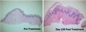 Thermi's Temperature-Controlled Radiofrequency System Improved Common Vaginal Disorders And Sexual Function, Published Study Shows