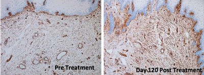 Histology of the vaginal mucosa before (left) and at Day 120 after (right) treatment with TTCRF. Post-treatment biopsy demonstrated denser submucosal stroma and increased vascularity. CD34, 100X. TTCRF, transcutaneous temperature-controlled radiofrequency. (Photo courtesy of Dermatologic Surgery)