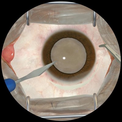 A view of the virtual eye through the microscope of the HelpMeSee Eye Surgery Simulator.