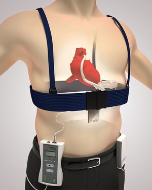 Leviticus Cardio Announces Successful Animal Trial Demonstrating Wireless Power to Jarvik 2000