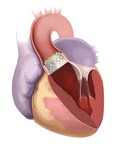 Minimizing the Risk of Repairing a Broken Heart