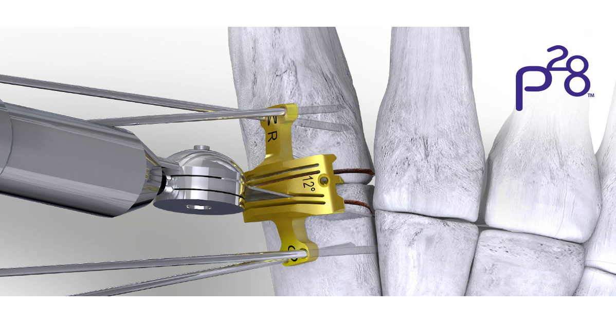 Paragon 28® launches a cut guide system specifically to control bone resection while addressing