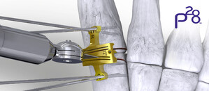 Paragon 28® launches a cut guide system specifically to control bone resection while addressing IM reduction in a Lapidus procedure