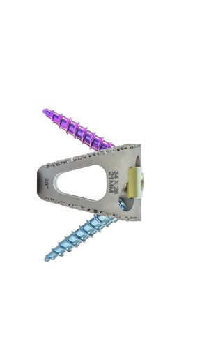 Renovis Surgical Receives FDA Clearance for Tesera Trabecular Technology™ Hyperlordotic ALIF Interbody Spinal Fusion System