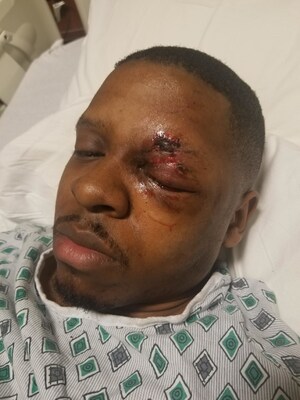 Man Injured From Fireworks Offers Advice This 4th Of July Holiday: "Don't Take The Risk - I Felt Like My Face Was Blown Off"