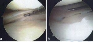 Stem Cells Shows Promise For Repairing Torn Meniscus