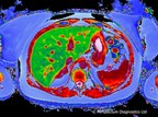 Large Population Imaging Study Reveals Utility of LiverMultiScan's Corrected T1 Measure as Potential Biomarker for Liver Health in Metabolic Diseases