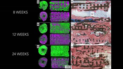 Three-dimensional imaging on the left shows how bone (pictured in green) replaced the bioactive ceramic scaffold (pictured in purple) over a six-month period. Microscope images on the right shows progressively increasing degrees of bone (stained pink) and lower amount of scaffold (black) as time goes by in the body. Photo credit: Journal of Tissue Engineering and Regenerative Medicine