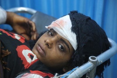Le 9 juin 2018, au Ymen, une jeune fille blesse est soigne dans un hpital,  Hodeidah.  UNICEF/UN0216979/Ayyashi (Groupe CNW/UNICEF Canada)