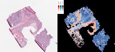 The image shows how an AI tool analyzes a slice of cancerous tissue to create a map that tells apart two lung cancer types, with squamous cell carcinoma in red, lung squamous cell carcinoma in blue, and normal lung tissue in gray.