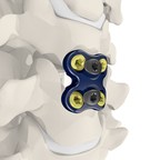 Meditech Spine Receives FDA Clearance for its Cure™ Opel-C Plating System