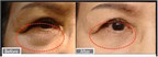 Revolutionary Device Allows Patients to Get Rid of Under Eye Fat Pads Without Surgery