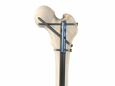 Apex Femoral Nailing System Antegrade Micromotion Ascending Screw Orientation