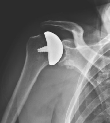 Stemless OVOMotion Implant System with Inlay Glenoid Xray