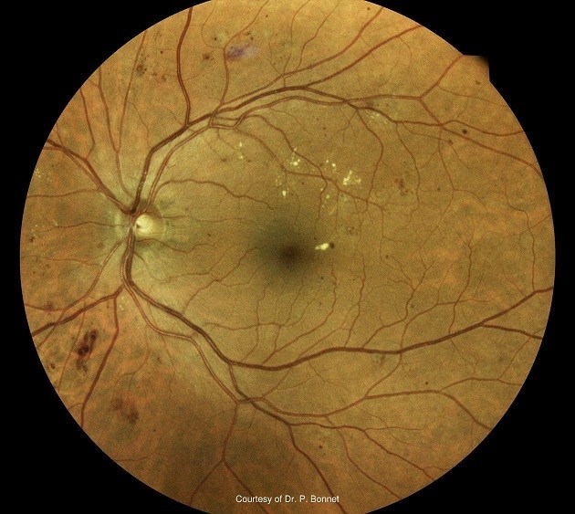 Diagnosis: Dry Age-Related Macular Degeneration. The 20/20NOW Eyelogic AI demonstrates focal areas of concern of hard exudates and drusen.