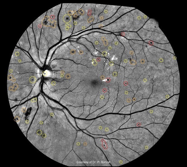 Diagnosis: Dry Age-Related Macular Degeneration. The 20/20NOW Eyelogic AI demonstrates focal areas of concern of hard exudates and drusen.