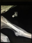 For the First Time Ever, Scientists Successfully Implant a Polymeric Prosthesis Imitating Bone Structure