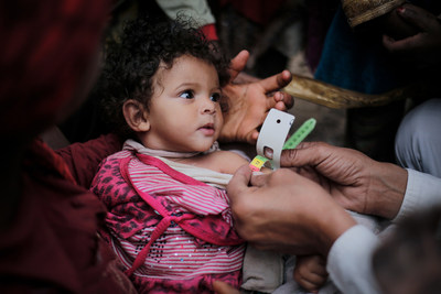 A medical practitioner uses a Mid Upper-Arm Circumference (MUAC) measuring tape on a child suffering from Severe Acute Malnutrition (SAM) in Bani Al-Harith, Sana'a, Yemen, Tuesday 14 February 2017.  UNICEF/UN057347/Almang (CNW Group/UNICEF Canada)