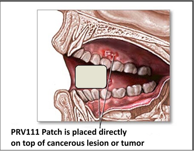 Privo's PRV 111 (topical patch) is placed directly onto a mucosal tissue. This topical patch is intended for the locoregional treatment of oral cavity squamous cell carcinoma without systemic toxicity.