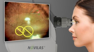 Navilas® 577s is the first retinal laser with a navigated non-contact treatment option for panretinal photocoagulation up to the far periphery. www.od-os.com/prp