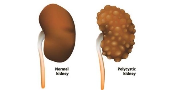 Research in Polycystic Kidney Disease Takes an Important Step Forward