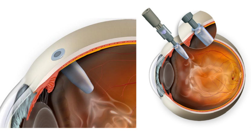 Easier, Potentially More Effective Treatment for Blinding Eye Disease ...