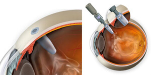 Easier, Potentially More Effective Treatment for Blinding Eye Disease Shows Promise in Clinical Trial