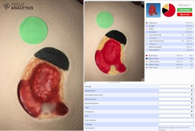 Wound Care Advantage partners with Tissue Analytics, combining 17 years of clinical data with AI and 3D imaging to improve patient outcomes.