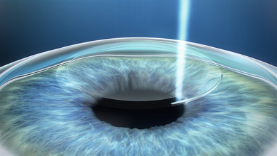 ZEISS Receives FDA Approval for ReLEx SMILE, Expanding Myopia Treatment to Patients with Astigmatism