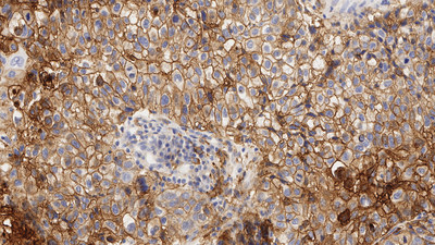 Non-small lung cancer, stained with PD-L1 BOND Ready-to-Use Primary Antibody (73-10), PA0832