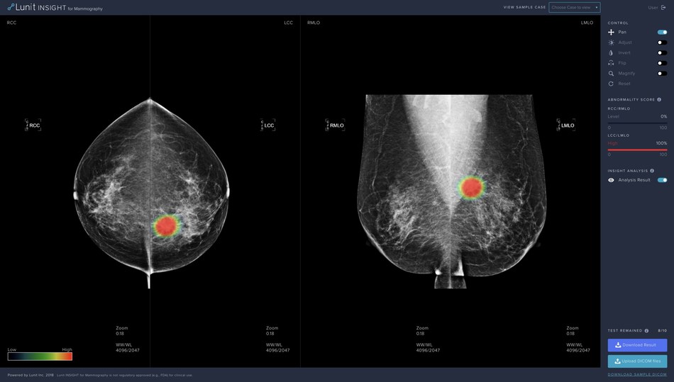 Lunit Brings its Newest AI Solution for Mammography to