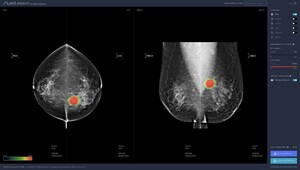 Lunit Brings its Newest AI Solution for Mammography to RSNA 2018