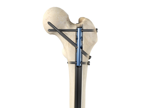 The ultimate evolution in femoral intramedullary nailing. The Apex Femoral Nailing System is the only femur nailing system on the market to feature micromotion fixation along with new trajectories of advanced locking options to offer unparalleled implant flexibility, resulting in optimum fixation for a wide range of femur fracture types. Image shows antegrade surgical implantation with ascending micromotion locking.