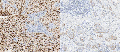 Left: Protein expression in mammary analogue secretory carcinoma with TRK fusion stained with VENTANA pan-TRK (EPR17341) Assay (20x)*  (*Fusion status based upon next generation sequencing reported from external laboratory developed test using OncomineTM Focus Assay[14-17])  Right: Protein expression in head and neck squamous cell carcinoma with wild-type TRK stained with VENTANA pan-TRK (EPR17341) Assay (20x)