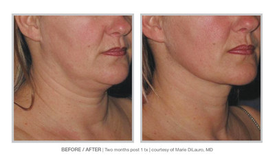1C;ALLURA Neck is all about rapid contour results with a single, office-based treatment,1D; says Marc Salzman MD, a Plastic Surgeon in Louisville, KY. 1C;It fits perfectly into my practice, next to non-invasive modalities like Coolsculpting Mini and Kybella. These procedures have the limitations of taking several months and sessions to attain modest results. With ALLURA Neck, the outcomes are profound within two weeks, 100% of the time. In addition, it is a high ROI procedure.1D;