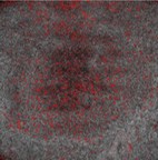 Michelson Diagnostics: Imaging Reveals Changes in Blood Vessel Growth in Deadly Melanoma Skin Cancer