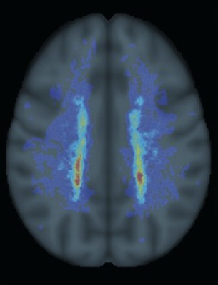NeuroRx Research Developed Novel Brain MRI Measures of Chronic Lesion Activity and Progressive Pathology in People With Multiple Sclerosis