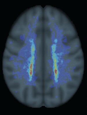 NeuroRx Research Developed Novel Brain MRI Measures of Chronic Lesion Activity and Progressive Pathology in People With Multiple Sclerosis