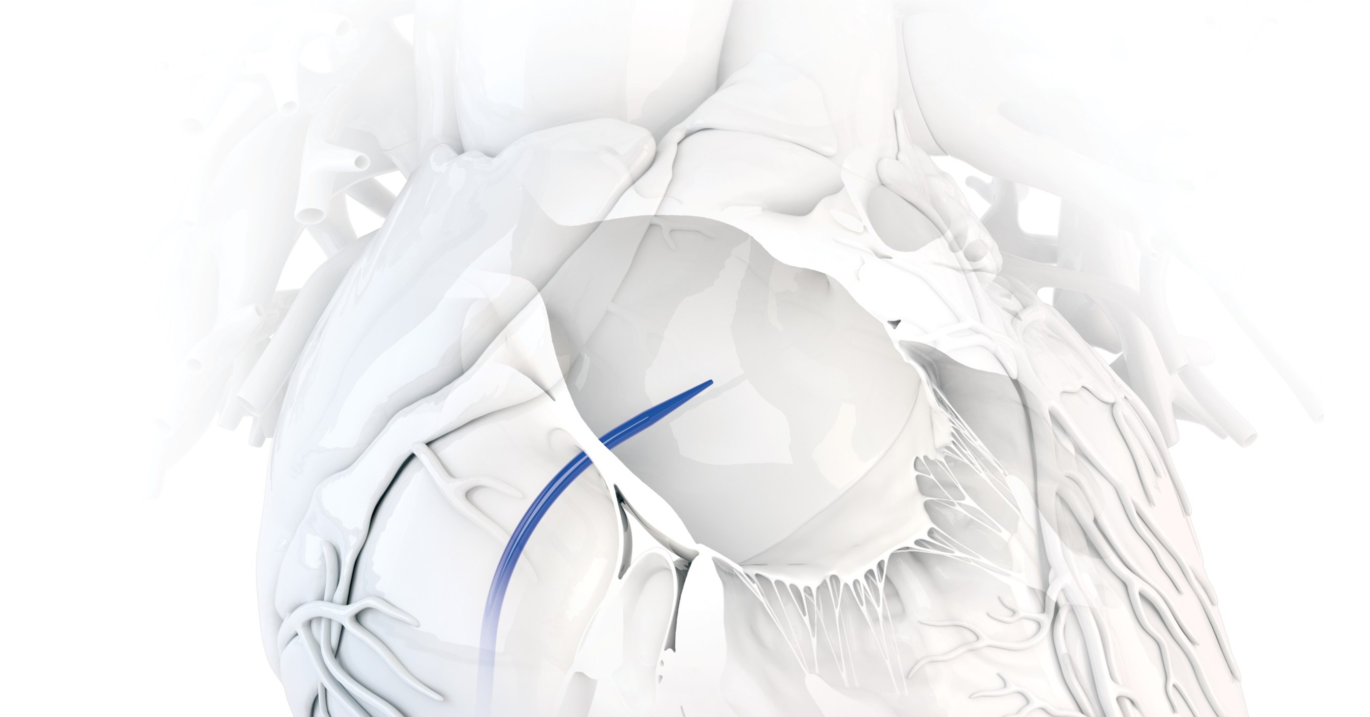 Baylis Medical Launches FirstofitsKind Large Access Transseptal Dilator