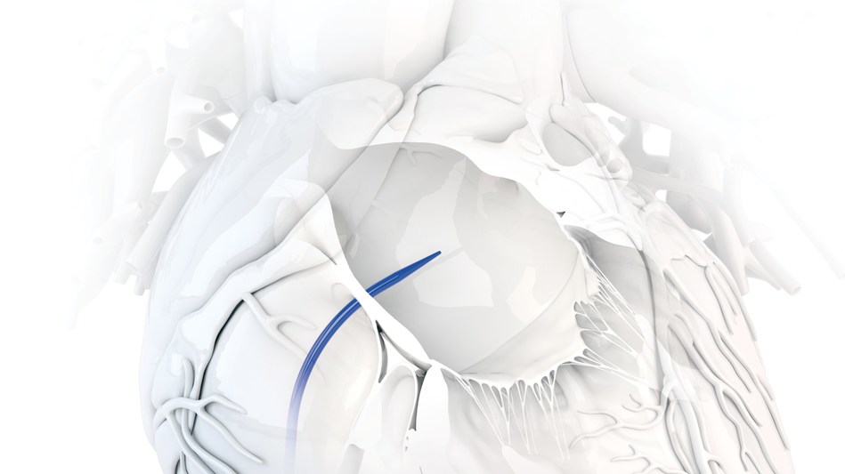 Baylis Medical Launches FirstofitsKind Large Access Transseptal Dilator
