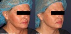 Bowes Dermatology by Riverchase está ofreciendo las técnicas más avanzadas para estirar la piel caída con el revolucionario procedimiento Silhouette InstaLift®