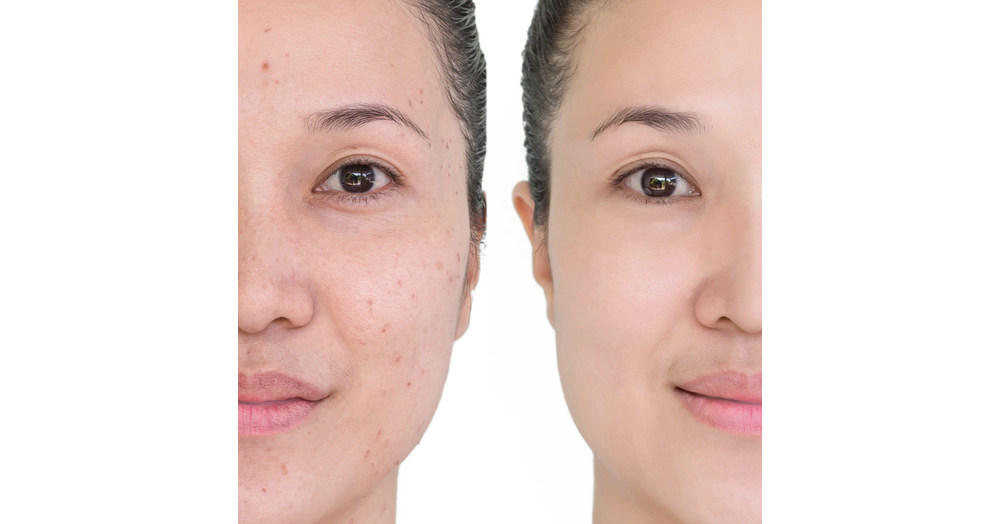 acne dark spots remover