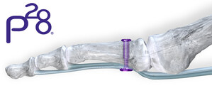 Paragon 28® launches first-of-its-kind in soft tissue fixation for the foot and ankle - TenoTac™ Soft Tissue Fixation System