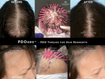 PDOgro(TM) - PDO Threads for Hair Regrowth