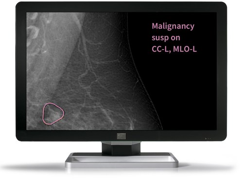 Mia presents the breast screening radiologist with a case-wise decision and highlights a region of interest