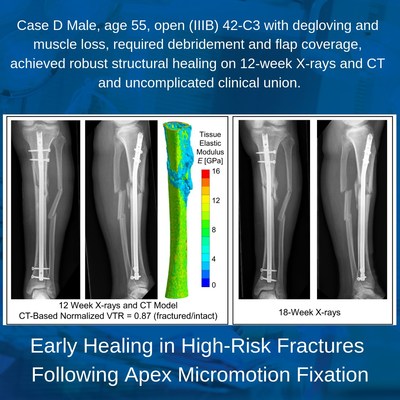 A sample case from the whitepaper featuring case reports of patients who were considered high risk for compromised fracture healing based on their injury characteristics or comorbidities and who achieved successful, uncomplicated clinical union following Apex micromotion fixation.